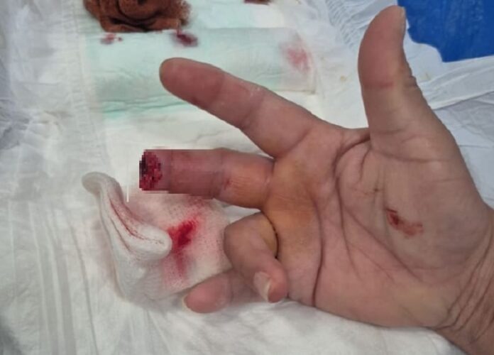 Paciente amputó un dedo a una enfermera de un mordisco en General Pinedo